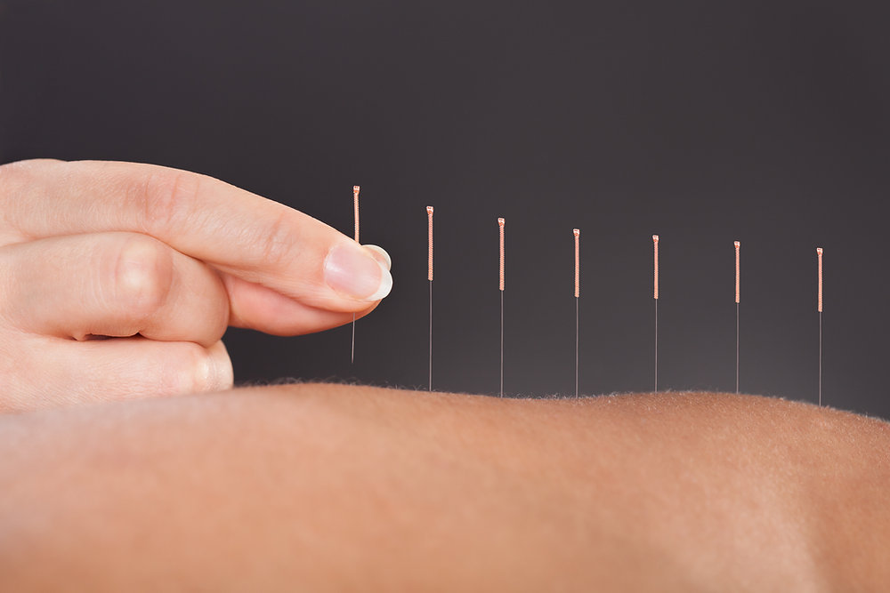 Ancient Acupuncture Healing